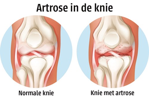 Artrose in de knie